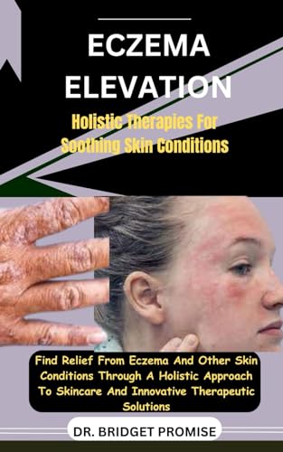 Eczema Elevation: Holistic Therapies For Soothing Skin Conditions: Find Relief From Eczema And Other Skin Conditions Through A Holistic Approach To Skincare And Innovative Therapeutic Solutions von Independently published